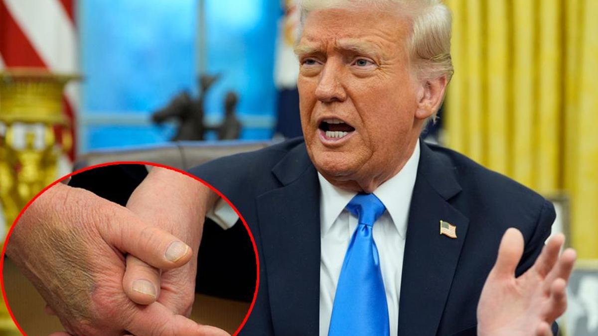 Trump’ın sağ elindeki morluk dikkat çekti: Beyaz Saray’dan açıklama geldi!